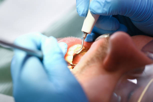Best Emergency Treatment for Dental Infections or Abscesses in Drum Point, MD