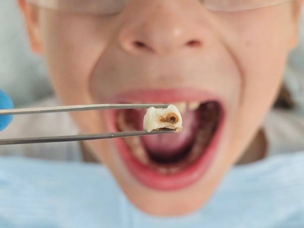 Best Urgent Care for Lost Fillings or Crowns in Drum Point, MD