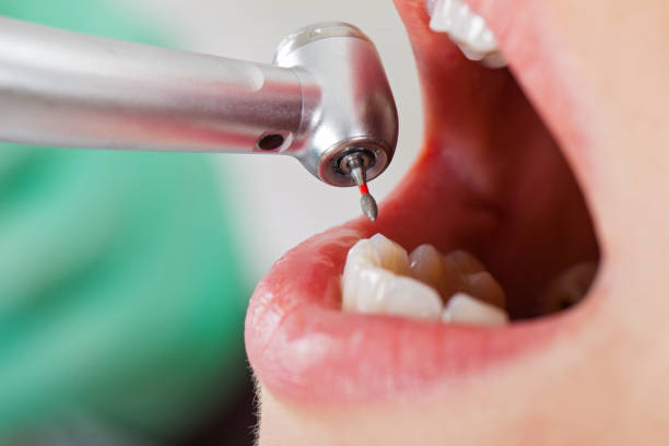 Best Emergency Wisdom Teeth Removal in Drum Point, MD